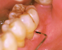 歯と歯茎の検査